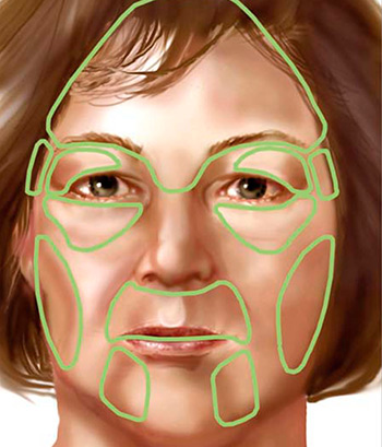 Lipoenxertia Facial