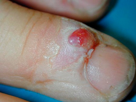 Lesão de pele